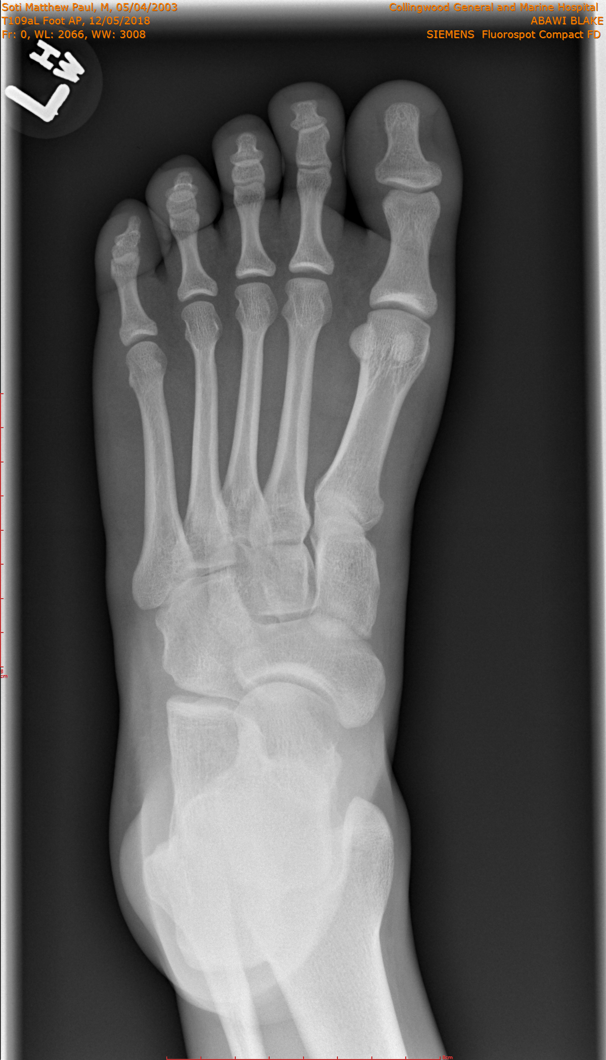 2018-12-05/T109aL Foot AP/0001-.png