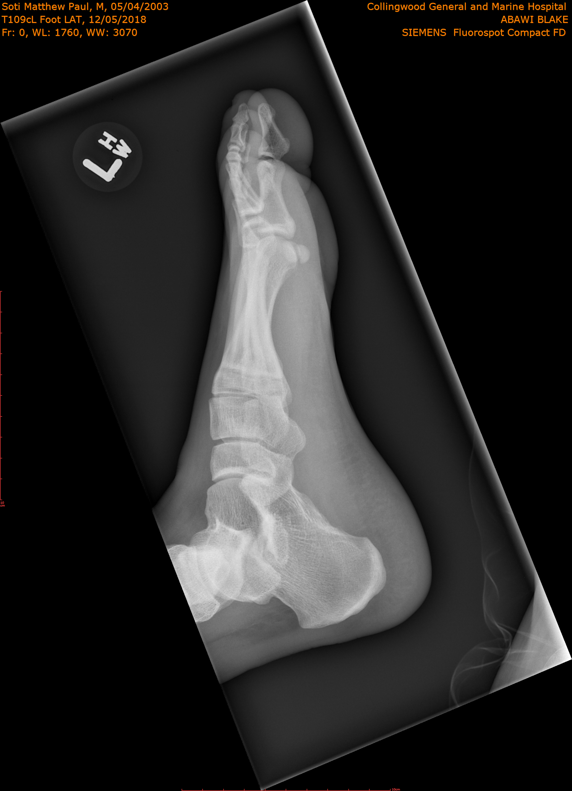 2018-12-05/T109cL Foot LAT/0001-.png