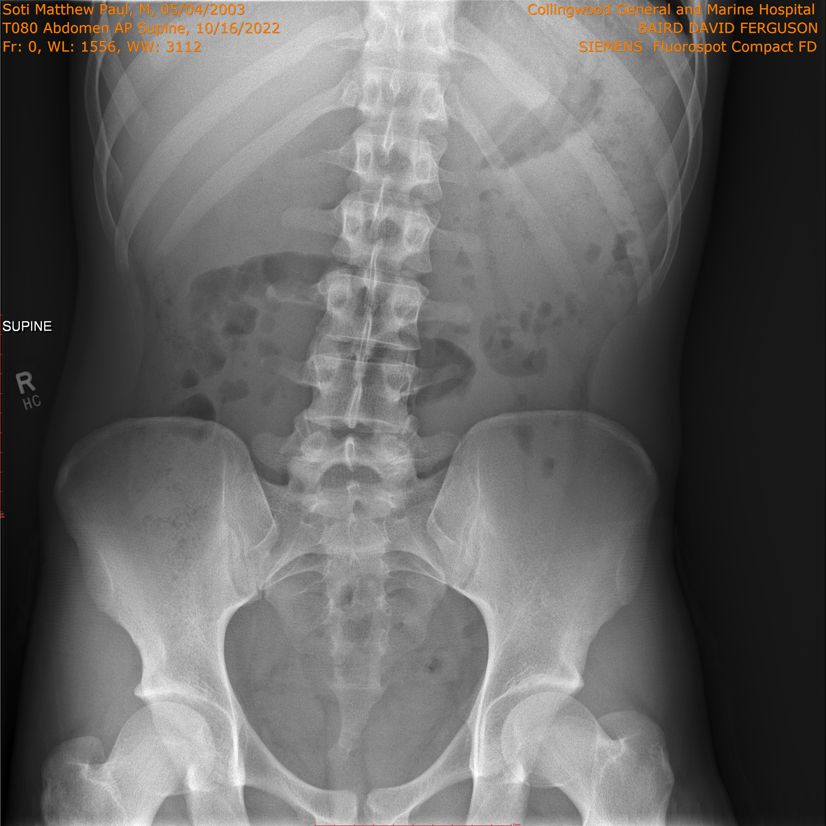 2022-10-16/T080 Abdomen AP Supine/0001-.png