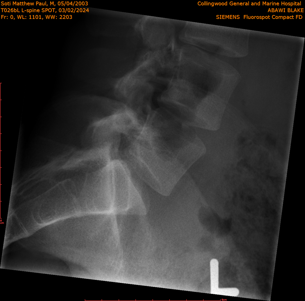 2024-03-02/T026bL L-spine SPOT/0001-.png