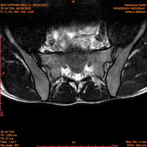 2025-06-09/3D AX T2W/0006-.png