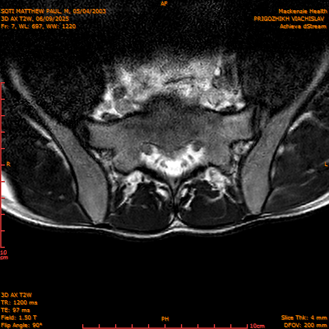 2025-06-09/3D AX T2W/0008-.png