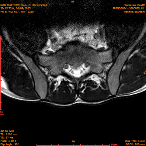 2025-06-09/3D AX T2W/0009-.png