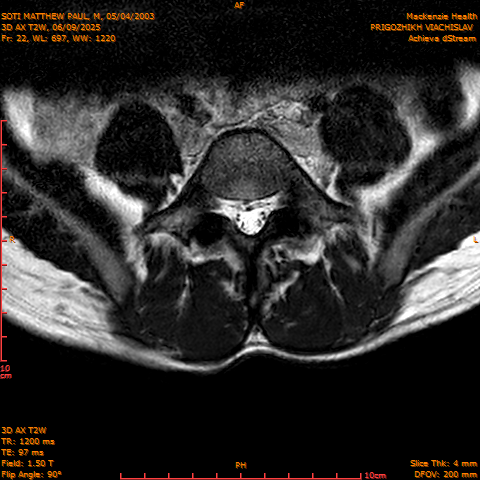 2025-06-09/3D AX T2W/0023-.png