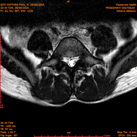 2025-06-09/3D AX T2W/0024-.png