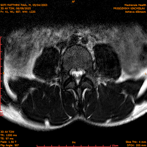2025-06-09/3D AX T2W/0042-.png
