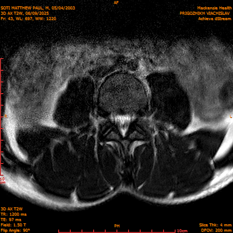 2025-06-09/3D AX T2W/0044-.png