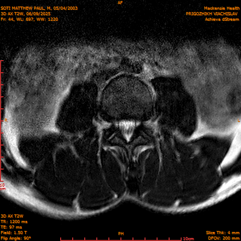2025-06-09/3D AX T2W/0045-.png