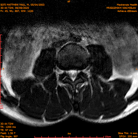 2025-06-09/3D AX T2W/0046-.png