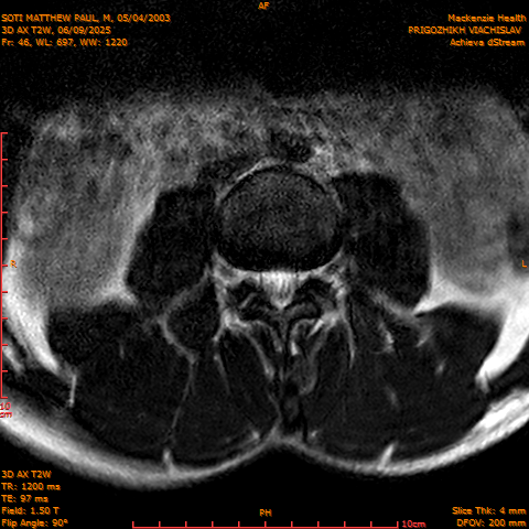 2025-06-09/3D AX T2W/0047-.png
