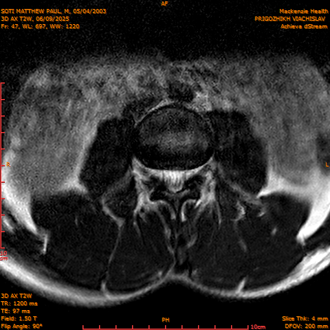 2025-06-09/3D AX T2W/0048-.png