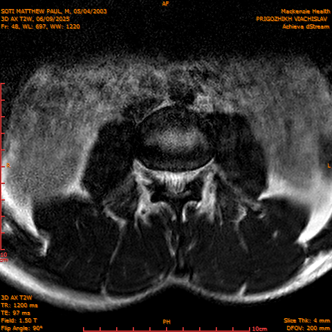 2025-06-09/3D AX T2W/0049-.png