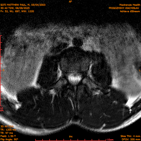 2025-06-09/3D AX T2W/0053-.png
