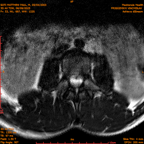 2025-06-09/3D AX T2W/0054-.png