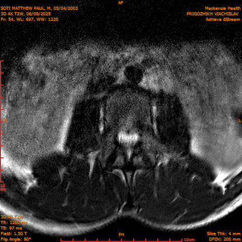 2025-06-09/3D AX T2W/0055-.png