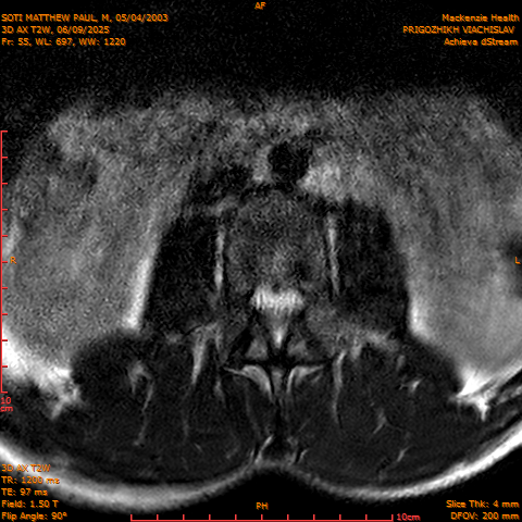 2025-06-09/3D AX T2W/0056-.png