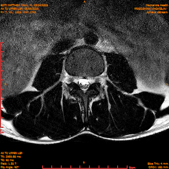 2025-06-09/AX T2 UPPER LSP/0008-IM169.png