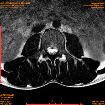 2025-06-09/AX T2 UPPER LSP/0010-IM171.png
