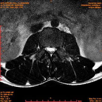 2025-06-09/AX T2 UPPER LSP/0012-IM173.png
