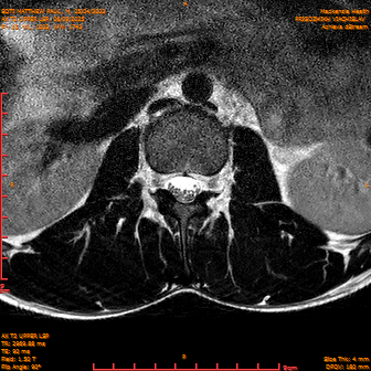 2025-06-09/AX T2 UPPER LSP/0016-IM177.png