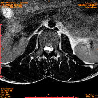 2025-06-09/AX T2 UPPER LSP/0018-IM179.png