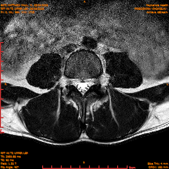 2025-06-09/RPT AX T2 UPPPER LSP/0001-IM223.png