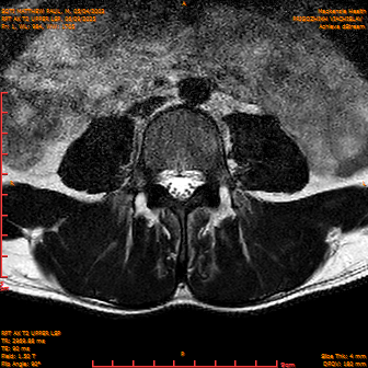 2025-06-09/RPT AX T2 UPPPER LSP/0002-IM224.png