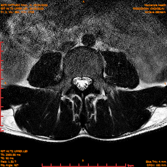 2025-06-09/RPT AX T2 UPPPER LSP/0003-IM225.png