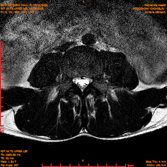 2025-06-09/RPT AX T2 UPPPER LSP/0004-IM226.png