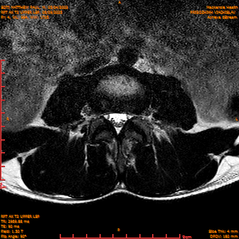 2025-06-09/RPT AX T2 UPPPER LSP/0005-IM227.png