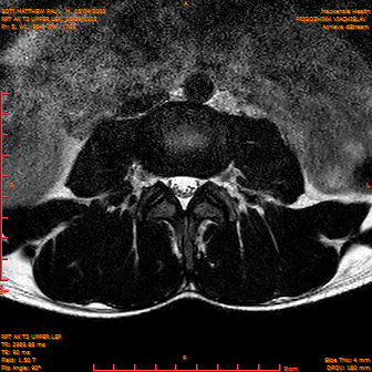 2025-06-09/RPT AX T2 UPPPER LSP/0006-IM228.png