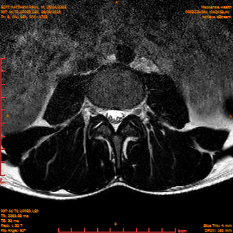 2025-06-09/RPT AX T2 UPPPER LSP/0007-IM229.png