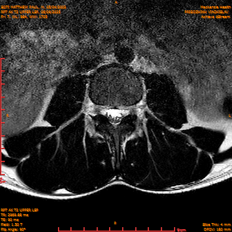 2025-06-09/RPT AX T2 UPPPER LSP/0008-IM230.png
