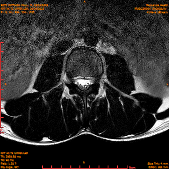 2025-06-09/RPT AX T2 UPPPER LSP/0009-IM231.png