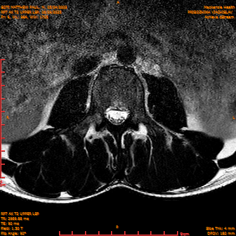 2025-06-09/RPT AX T2 UPPPER LSP/0010-IM232.png