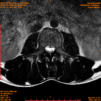 2025-06-09/RPT AX T2 UPPPER LSP/0011-IM233.png