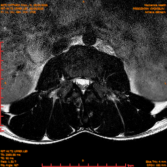 2025-06-09/RPT AX T2 UPPPER LSP/0012-IM234.png