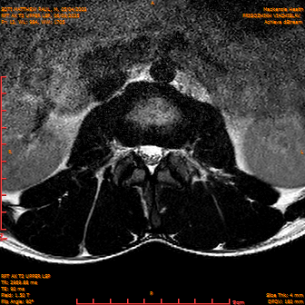 2025-06-09/RPT AX T2 UPPPER LSP/0013-IM235.png