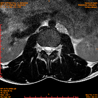 2025-06-09/RPT AX T2 UPPPER LSP/0015-IM237.png