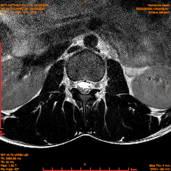 2025-06-09/RPT AX T2 UPPPER LSP/0016-IM238.png