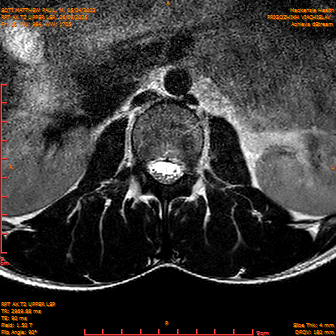 2025-06-09/RPT AX T2 UPPPER LSP/0017-IM239.png