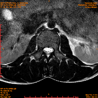 2025-06-09/RPT AX T2 UPPPER LSP/0019-IM241.png