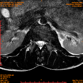 2025-06-09/RPT AX T2 UPPPER LSP/0020-IM242.png