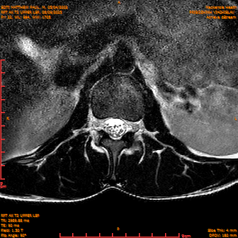 2025-06-09/RPT AX T2 UPPPER LSP/0023-IM245.png