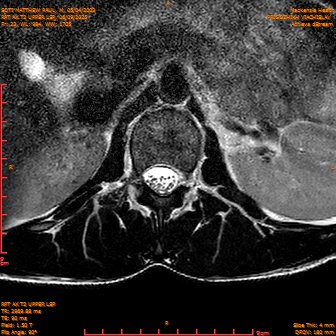 2025-06-09/RPT AX T2 UPPPER LSP/0024-IM246.png
