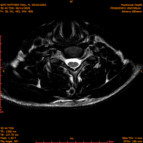 2025-06-14/3D AX T2W/0029-.png
