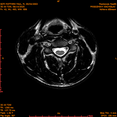 2025-06-14/3D AX T2W/0043-.png