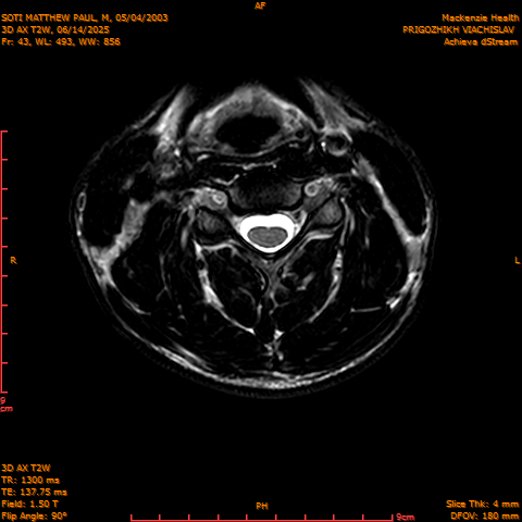 2025-06-14/3D AX T2W/0044-.png