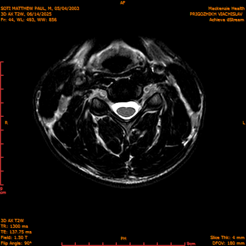 2025-06-14/3D AX T2W/0045-.png