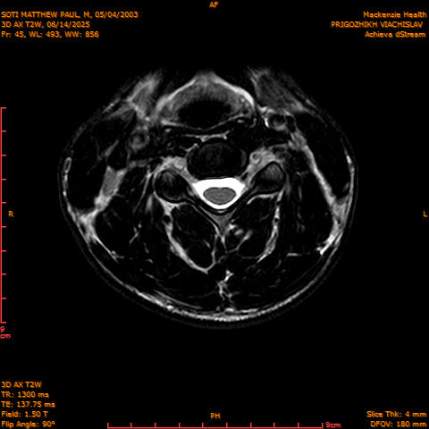 2025-06-14/3D AX T2W/0046-.png